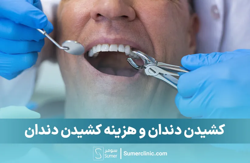 کشیدن دندان و هزینه کشیدن دندان