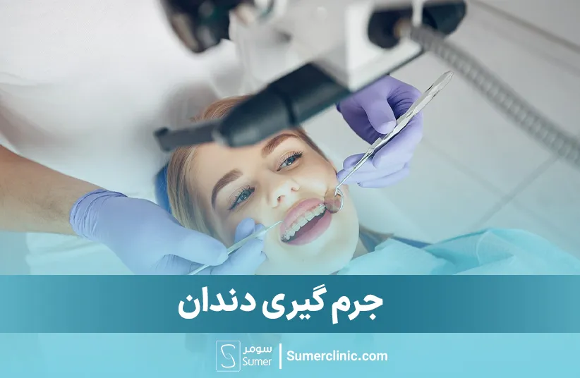 جرم گیری دندان