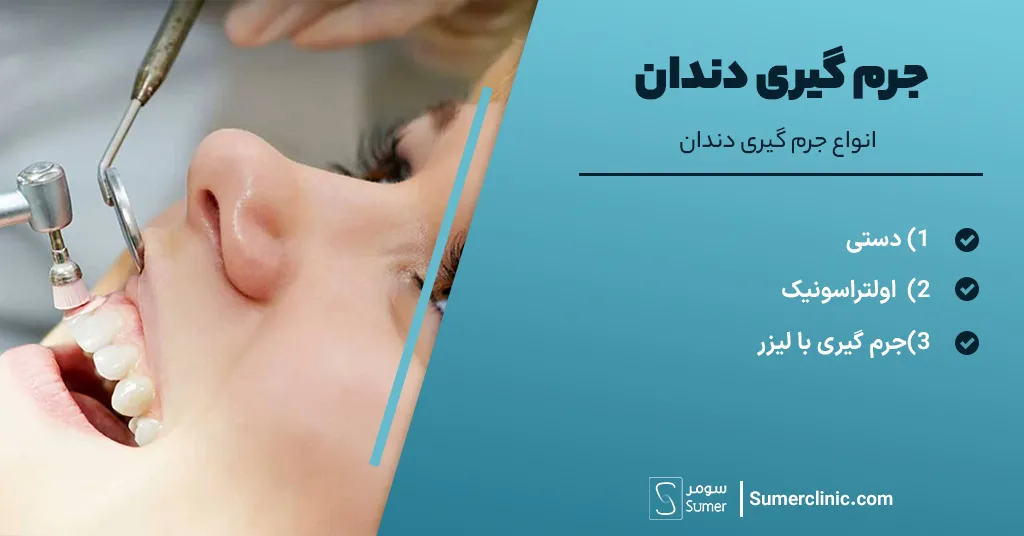 انواع جرم گیری دندان