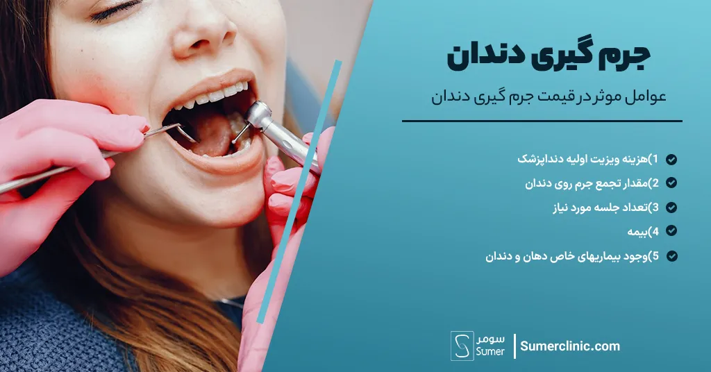 عوامل موثر در قیمت جرم گیری دندان