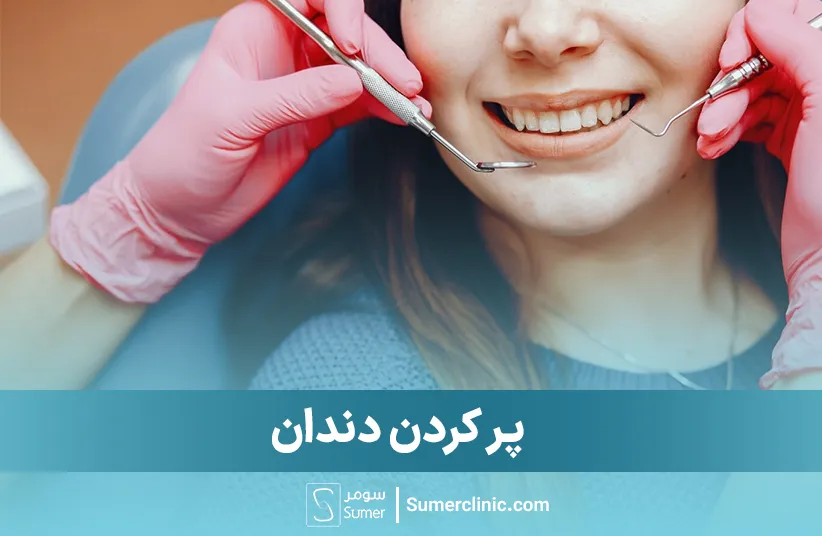 پرکردن دندان