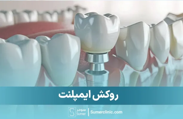 روکش ایمپلنت