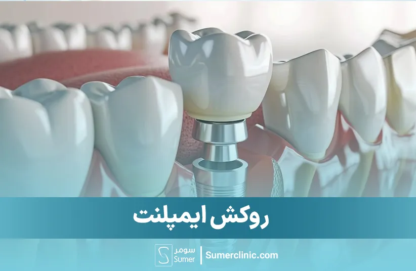 روکش ایمپلنت