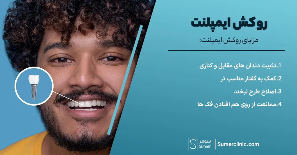 مزایا روکش ایمپلنت
