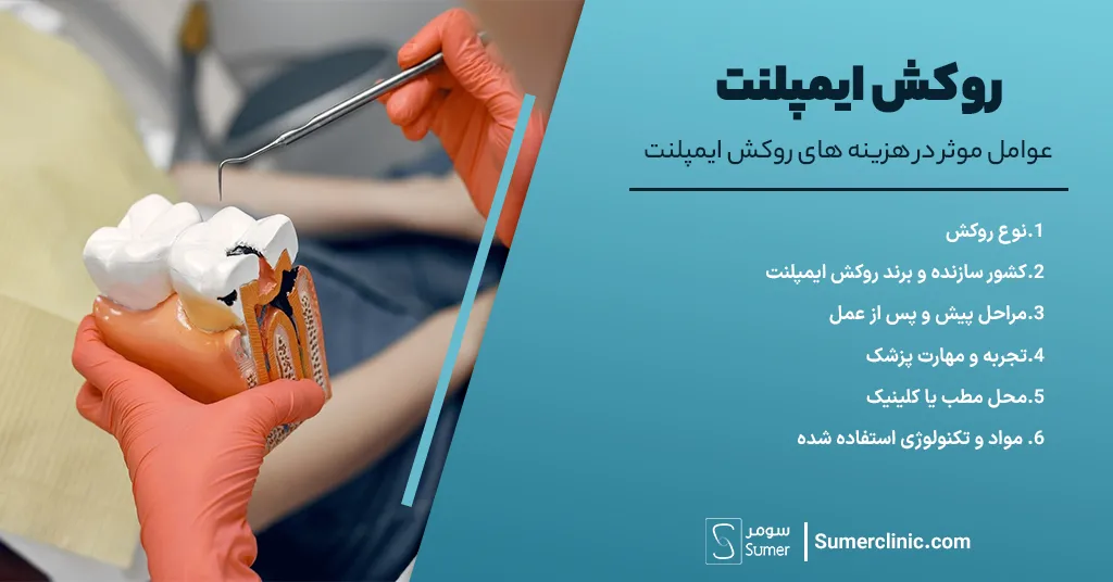 عوامل موثر در هزینه های روکش ایمپلنت