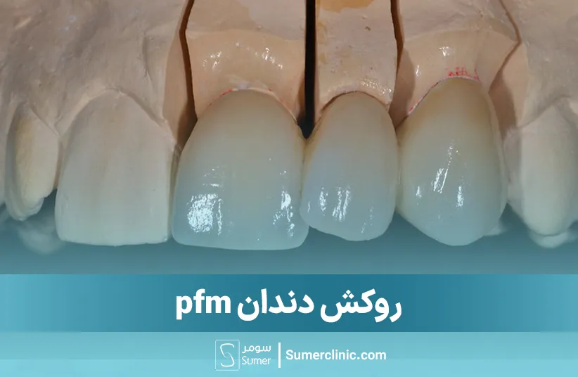 روکش دندان pfm