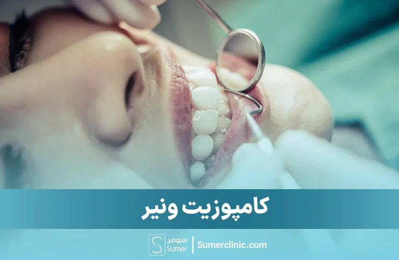 کامپوزیت ونیر