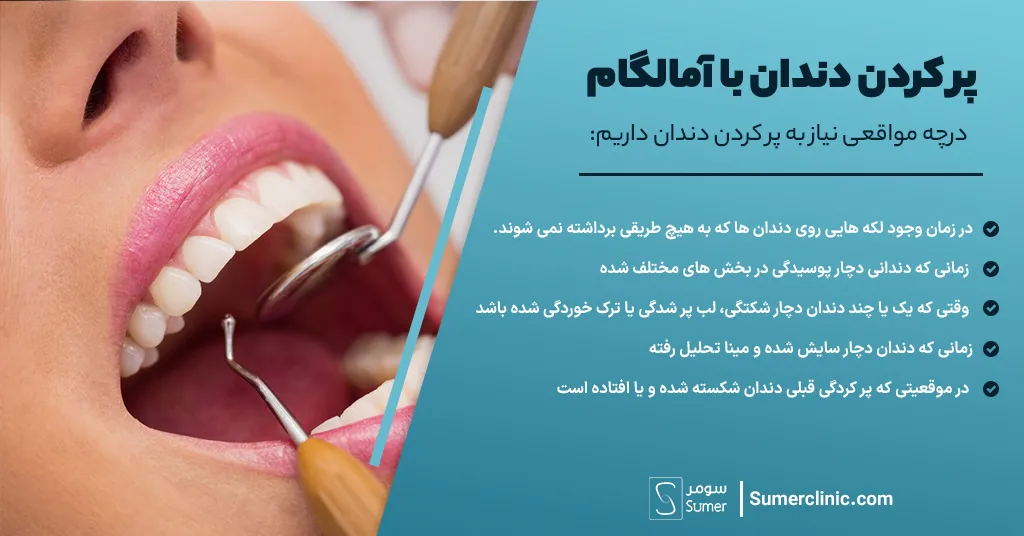 در چه مواقعی نیاز به پرکردن دندان داریم؟