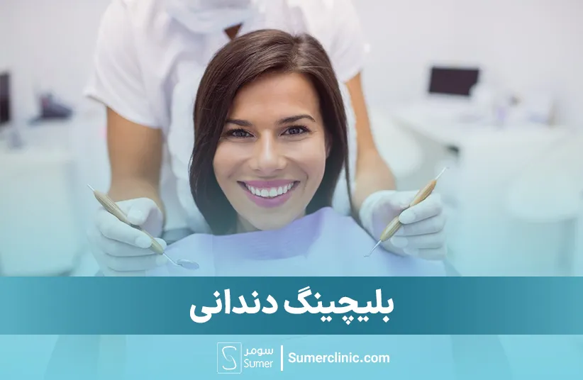 بلیچینگ دندان