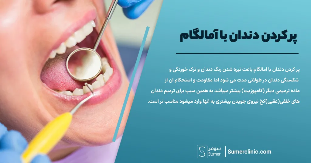 مزایا و معایب پر کردن دندان با آمالگام