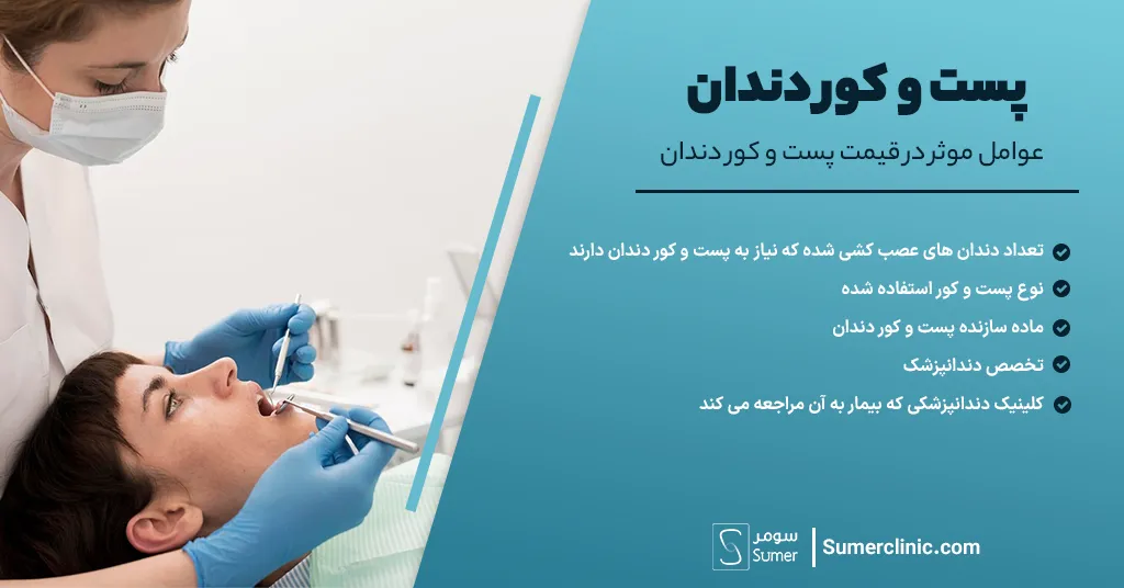 عوامل موثر در قیمت پست و کور دندان