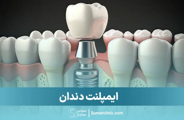 ایمپلنت دندان
