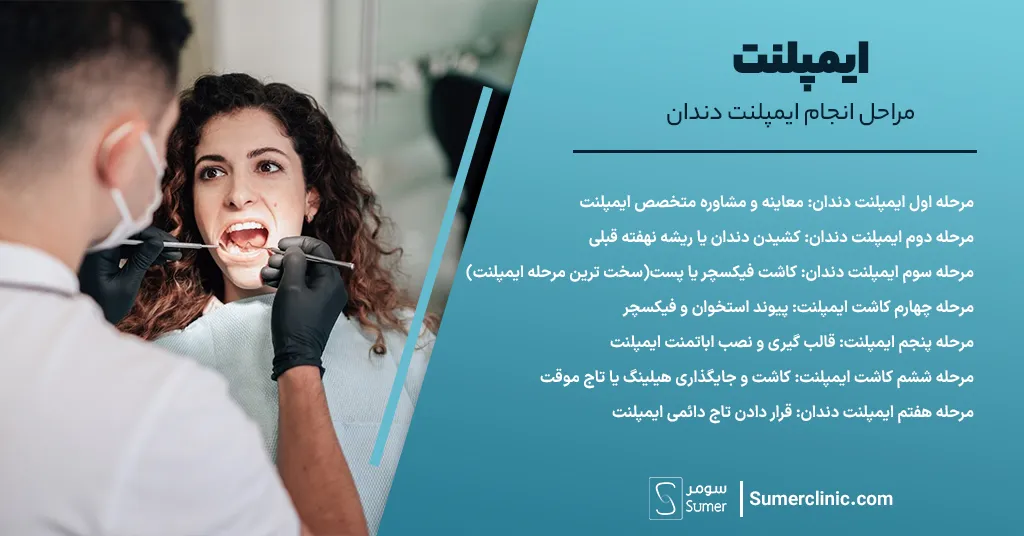 مراحل انجام ایمپلنت دندان