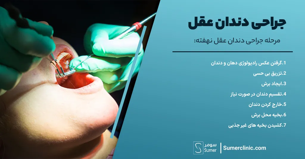 مراحل جراحی دندان عقل