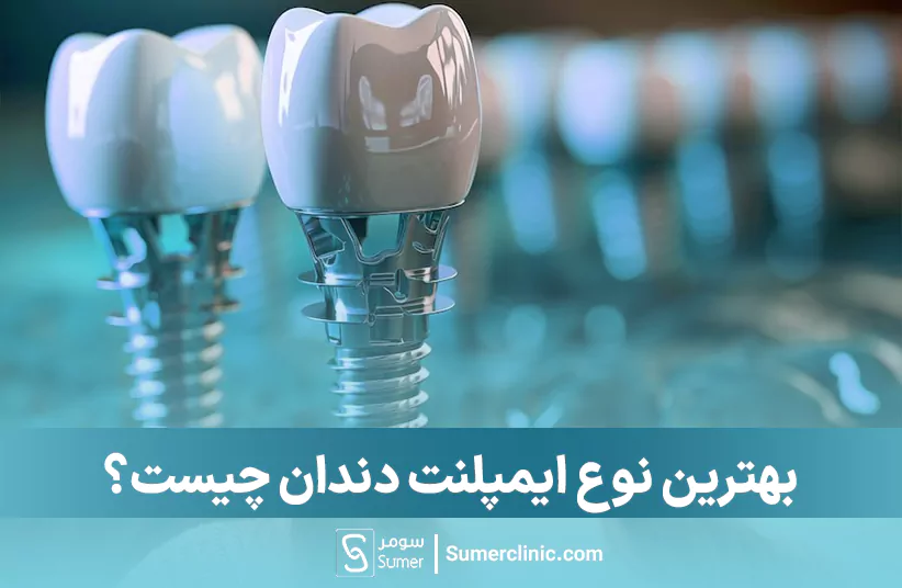 بهترین نوع ایمپلنت