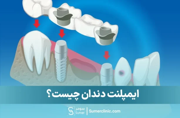 ایمپلنت دندان چیست؟