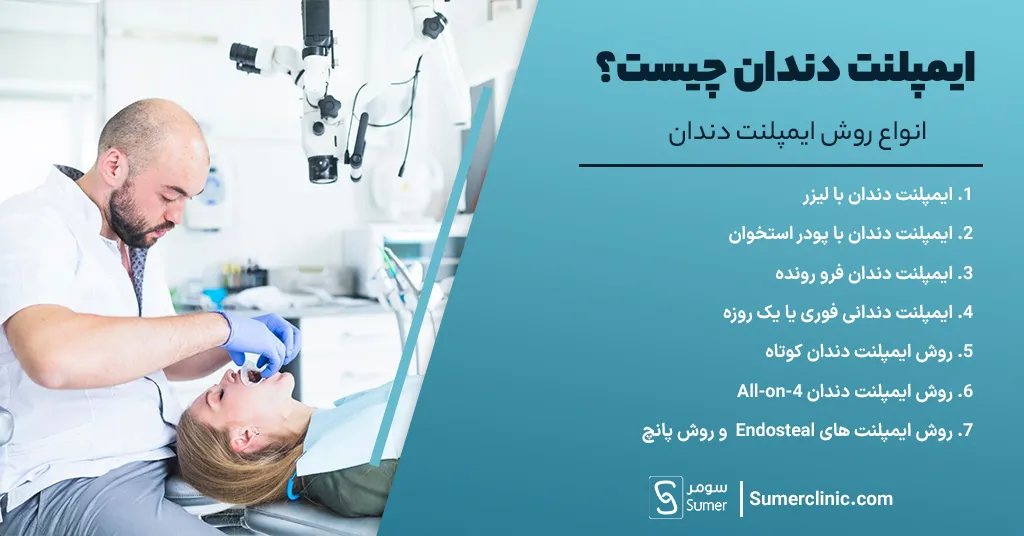 انواع روش ایمپلنت دندان