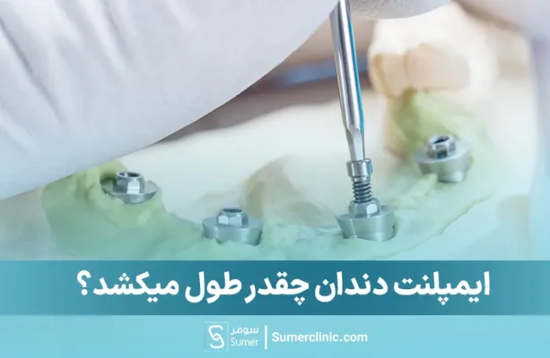 ایمپلنت دندان چقدر طول میکشد؟