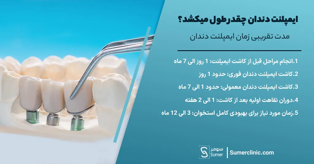 مدت تقریبی زمان ایمپلنت دندان