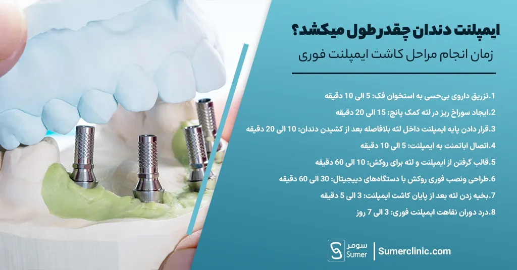 انجام مراحل کاشت ایمپلنت فوری دندان چه قدر طول میکشد؟